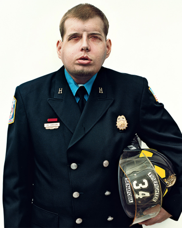 Inside the Historic Face Transplant of Hero Firefighter